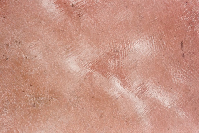 pelle con cicatrici da acne
