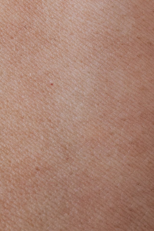 esempio di pelle del corpo disidratata